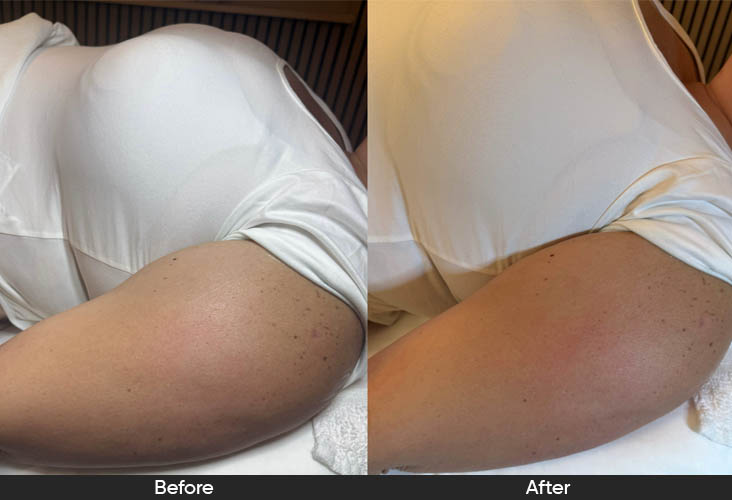 service_cavitation_arms